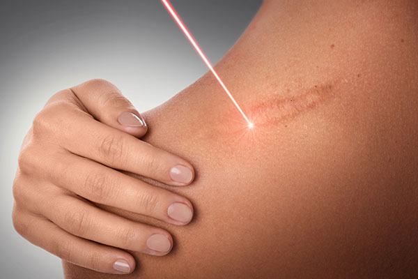 7-K-Laser-scar-tissue.